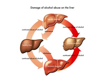 Scoperti geni che aumentano rischi di epatite alcolica