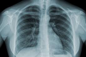  New England Journal of Medicine: 3,5 milioni gli italiani con difficoltà respiratorie