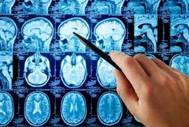 Alcol: panoramica degli effetti sul cervello