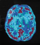 L'uso di alcol e droghe danneggia sempre il cervello: ecco come