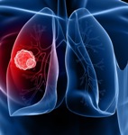 International Journal of Cancer: tumore al polmone, è allarme tra le giovani donne