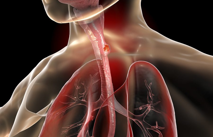 ll tumore all’esofago e l’importanza della prevenzione: attenzione al consumo di alcolici e sigarette