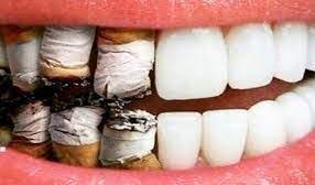 Il dentista risponde: fumare è dannoso per la bocca?