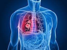 Tumore al polmone: fumo di sigaretta e fattori di rischio